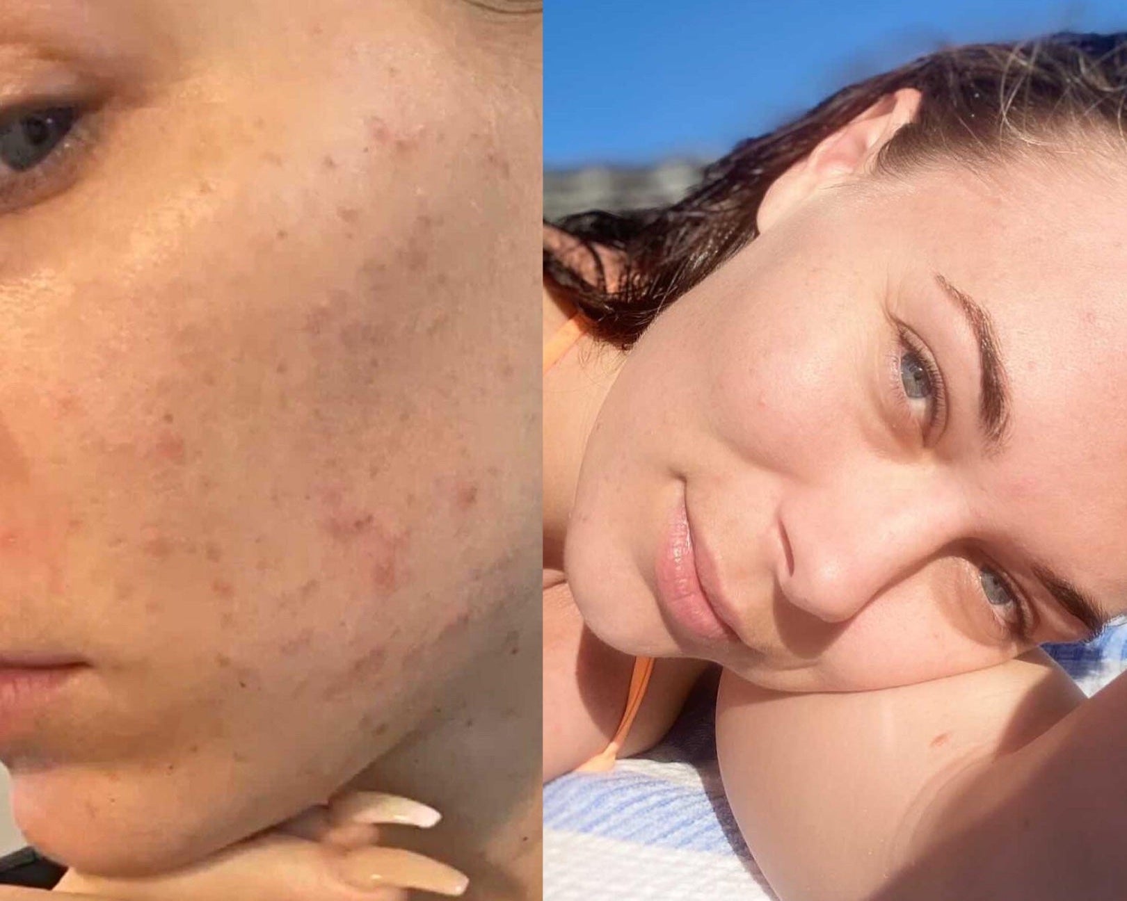 3 months of progress - Supple Skin Co
