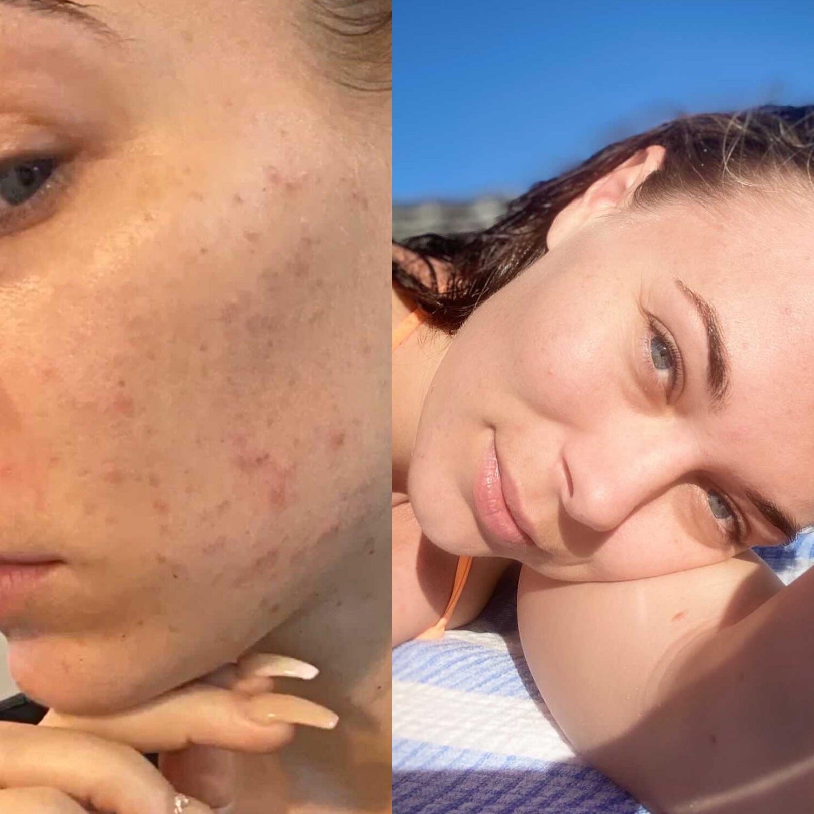 3 months of progress - Supple Skin Co