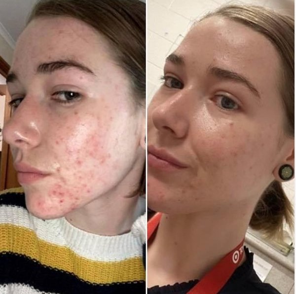30 Days Difference - Supple Skin Co