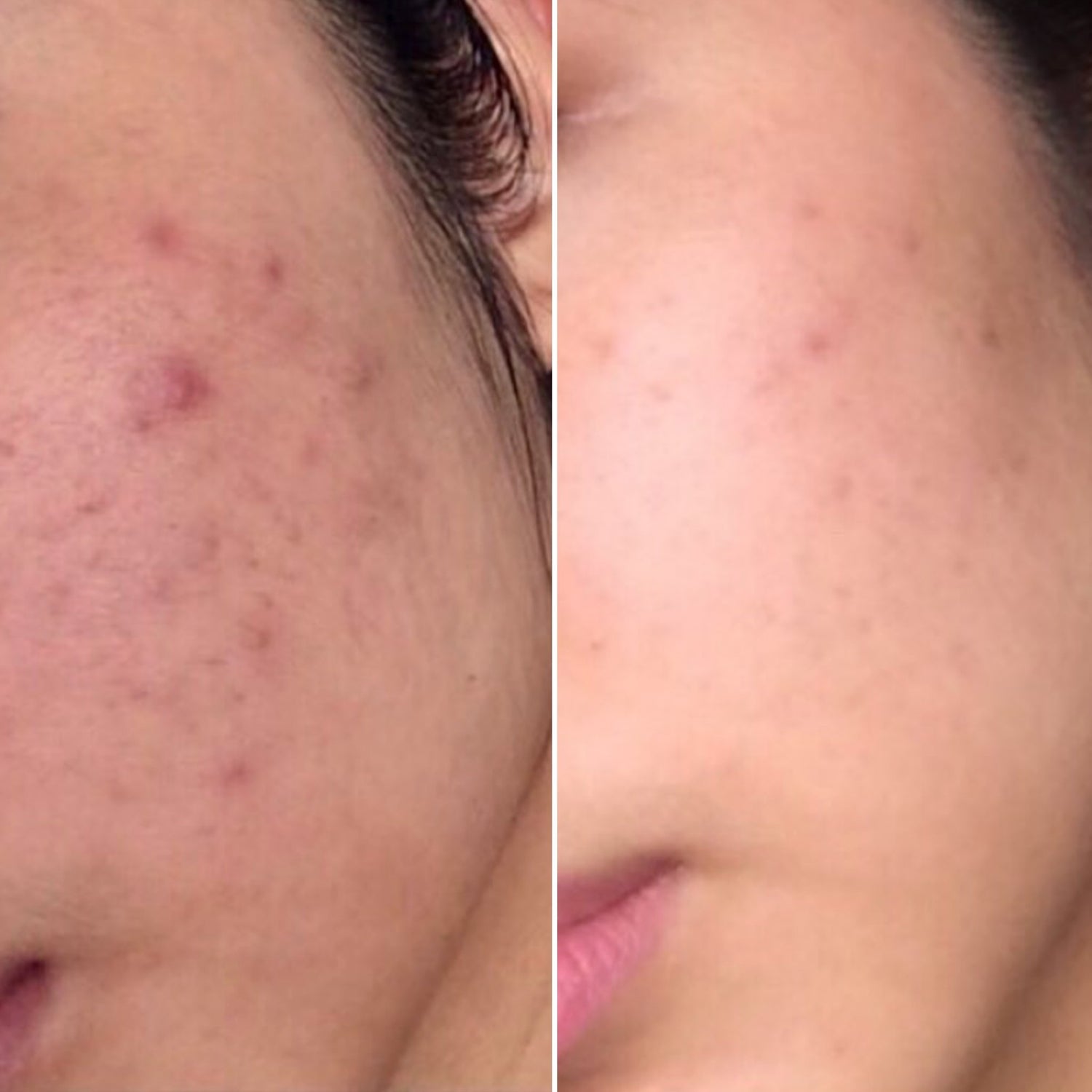 Acne & Scarring Reduction - Supple Skin Co