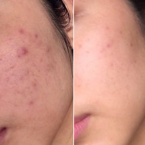 Acne & Scarring Reduction - Supple Skin Co