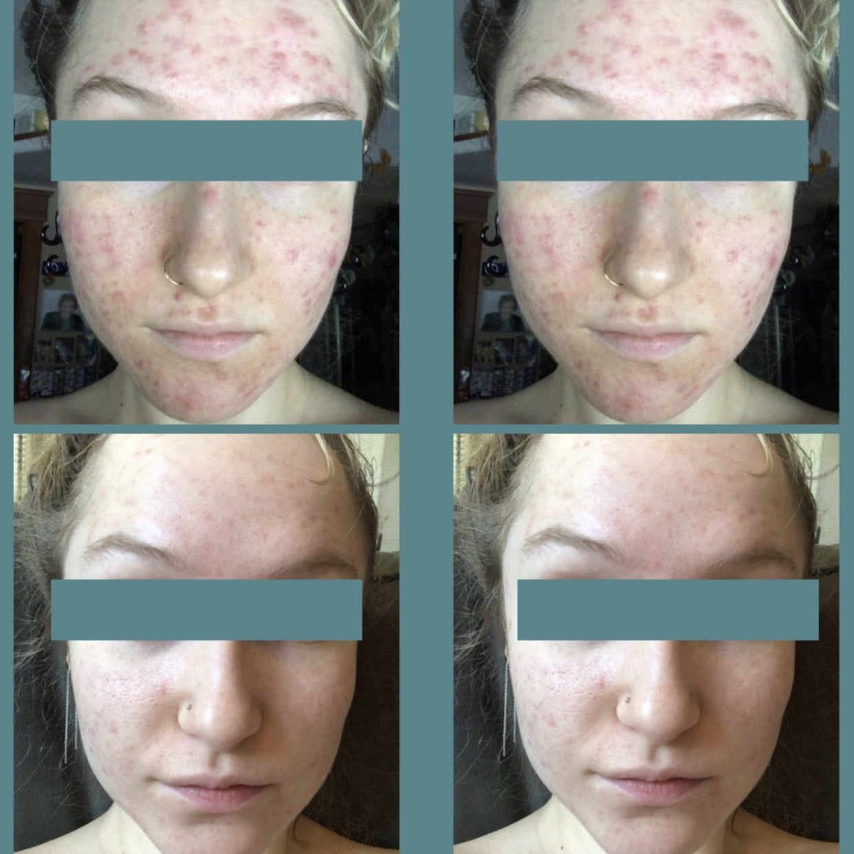 B & A Acne Prone Skin - Supple Skin Co