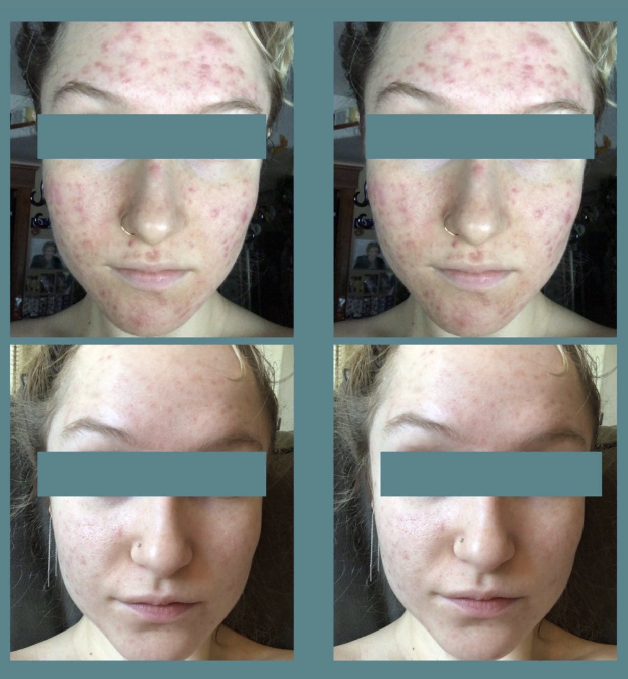 B & A Acne Prone Skin - Supple Skin Co