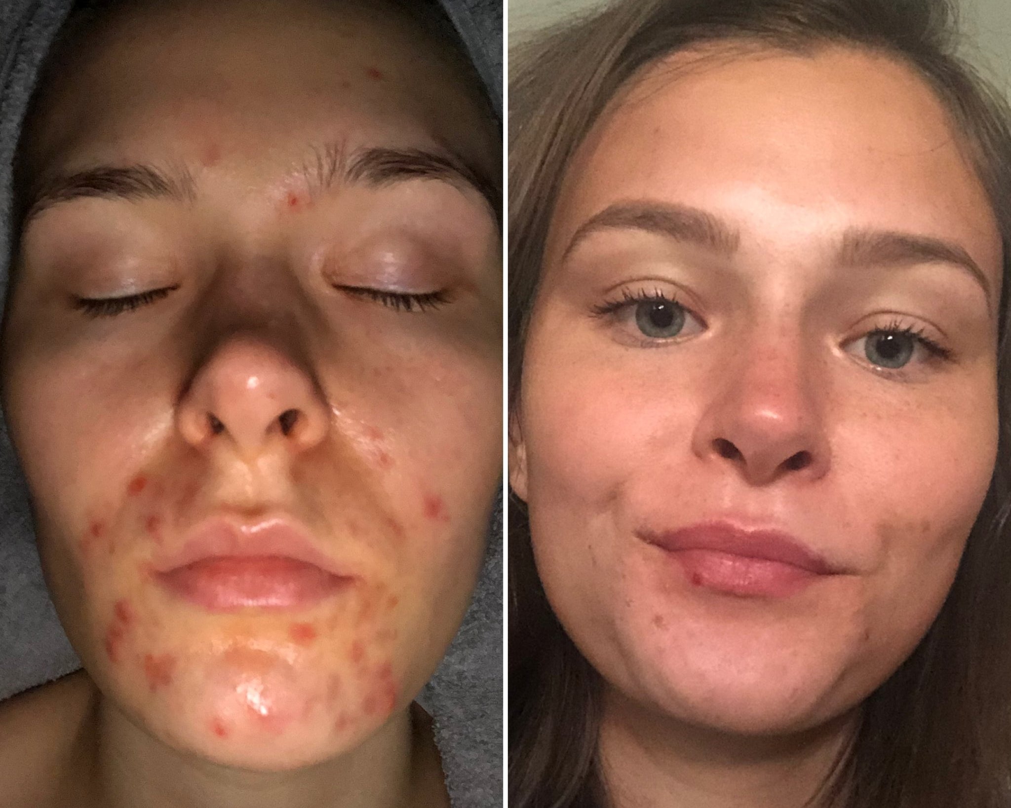 B & A : Acne that takes a little longer to heal - Supple Skin Co