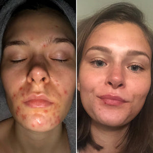 B & A : Acne that takes a little longer to heal - Supple Skin Co