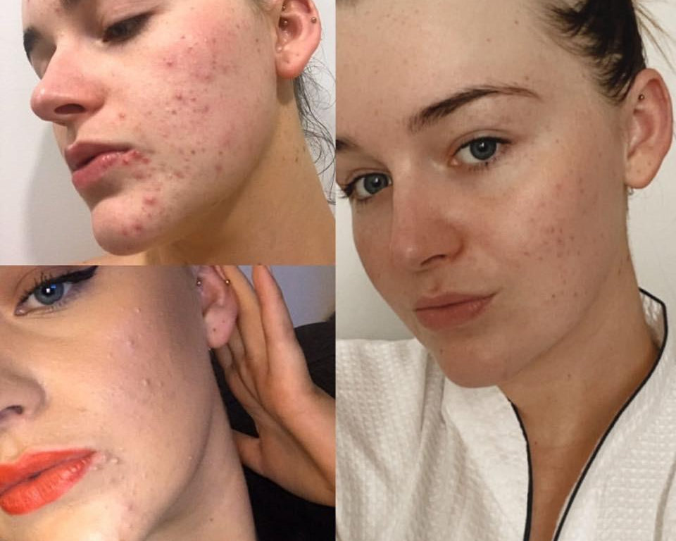 B&A Acne Prone - Supple Skin Co