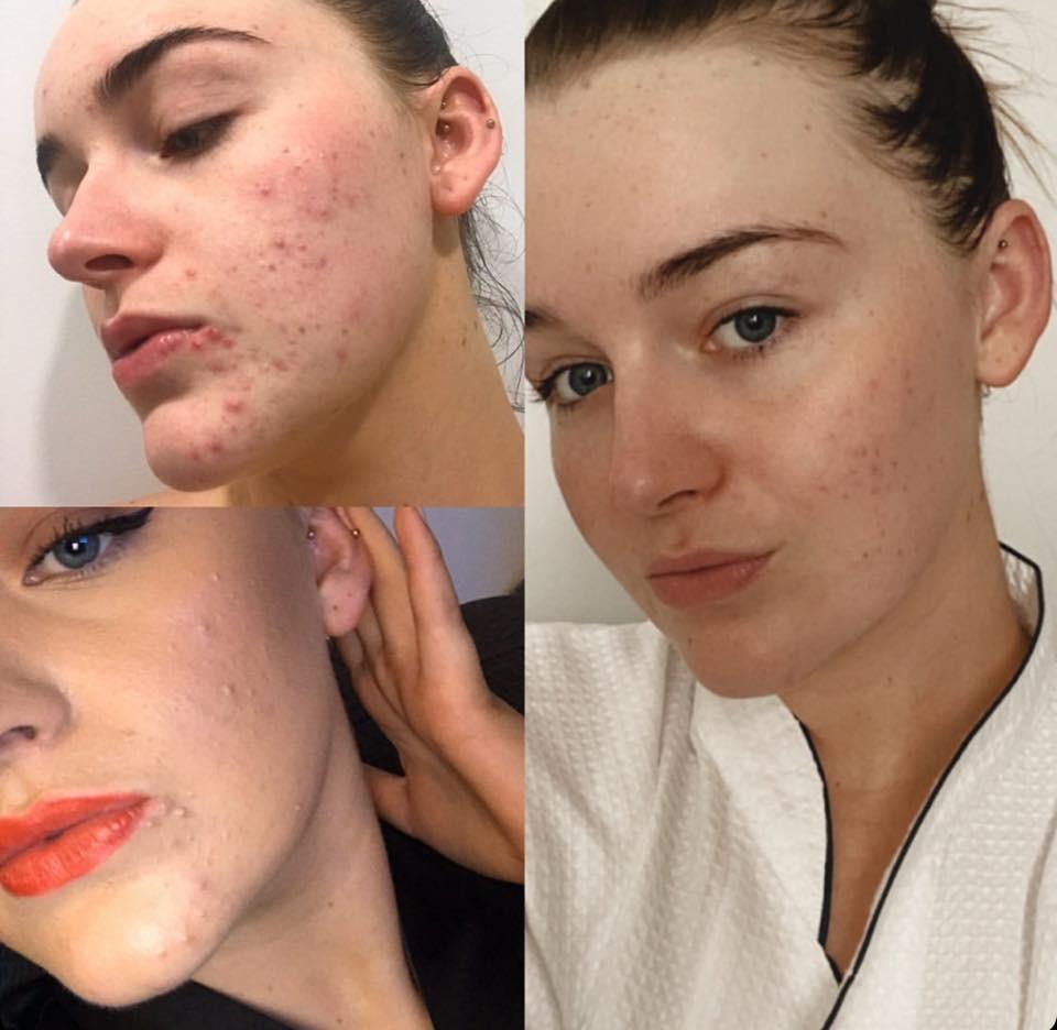 B&A Acne Prone - Supple Skin Co