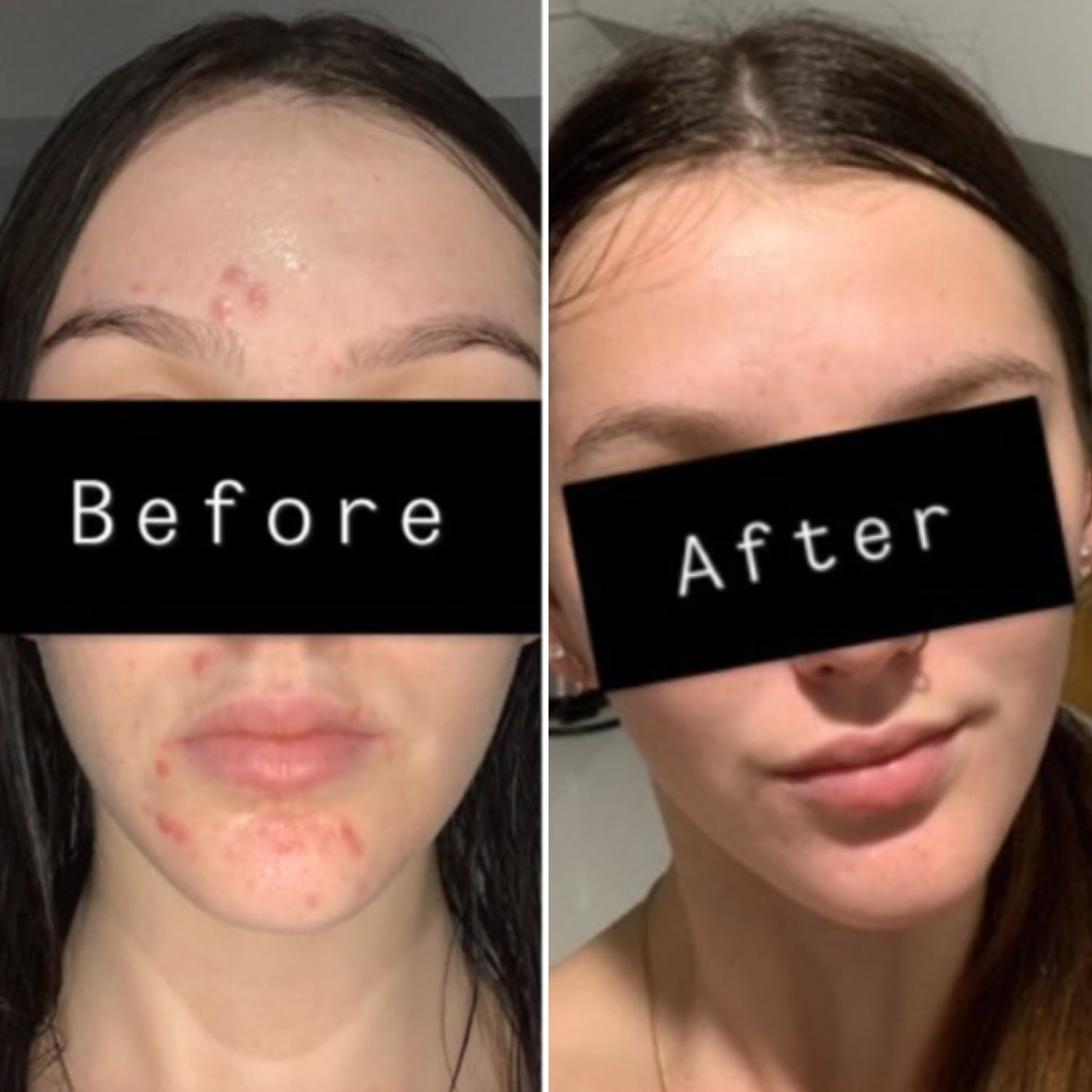 B&A Acne Prone - Supple Skin Co