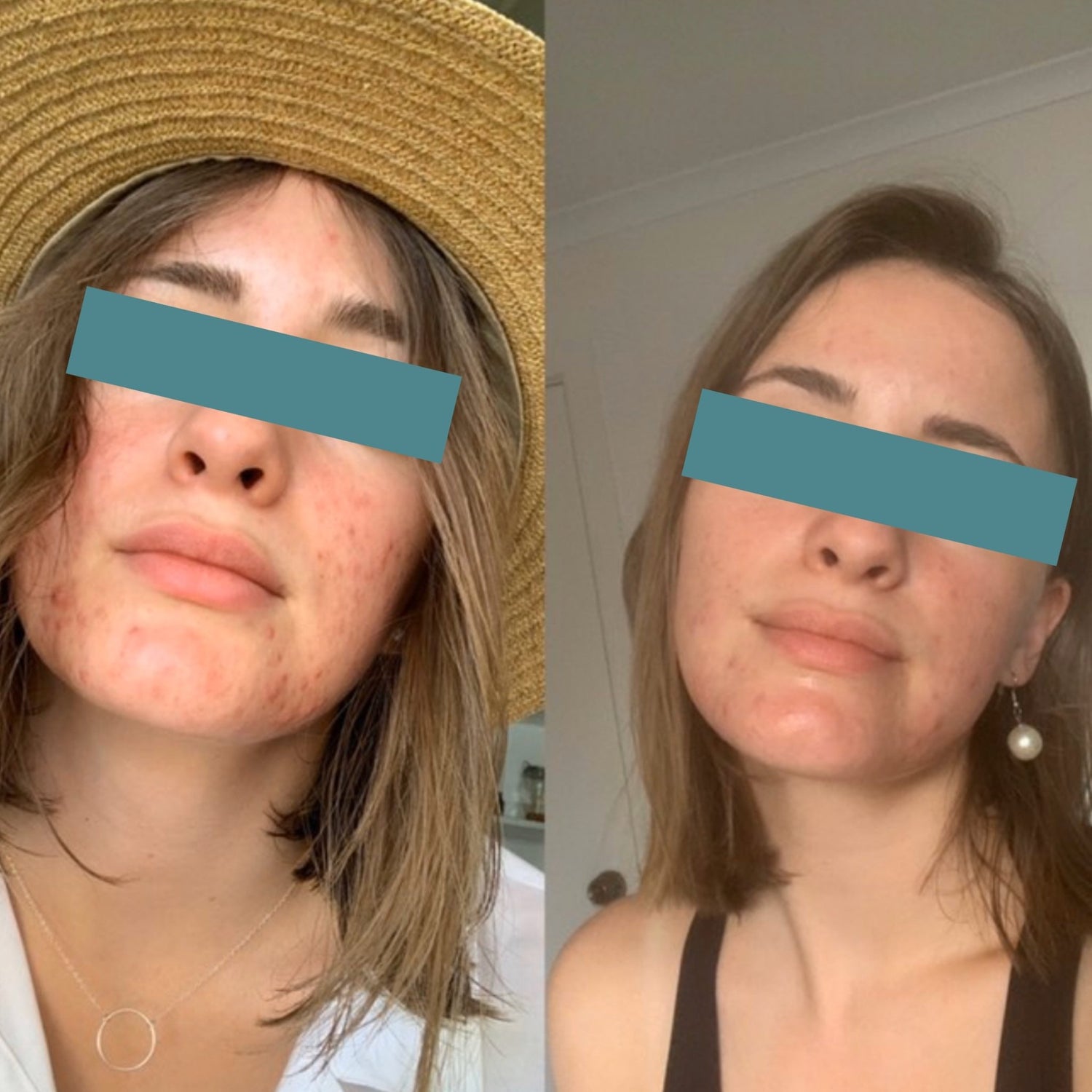 B&A Acne Prone & Scarring - Supple Skin Co