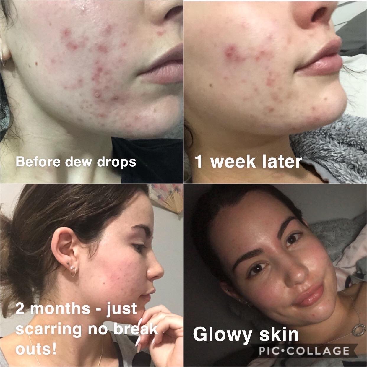 B&A Acne Prone Skin - Supple Skin Co