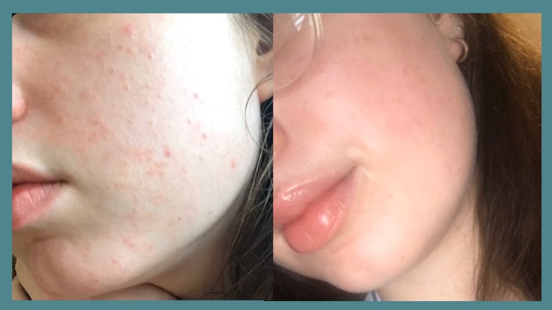 B&A Acne Prone Skin - Supple Skin Co