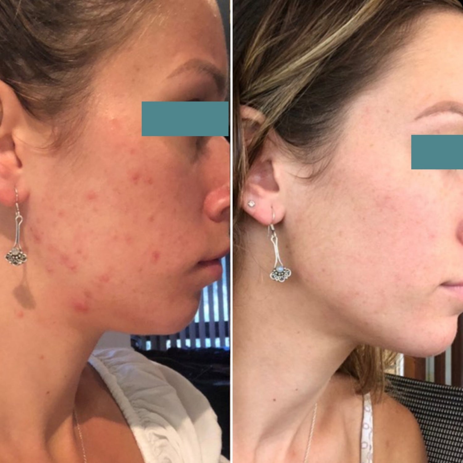 B&A Breakout Prone - Supple Skin Co