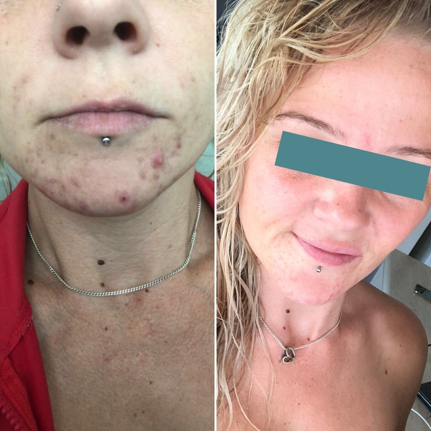 B&A Cystic Chin Acne - Supple Skin Co