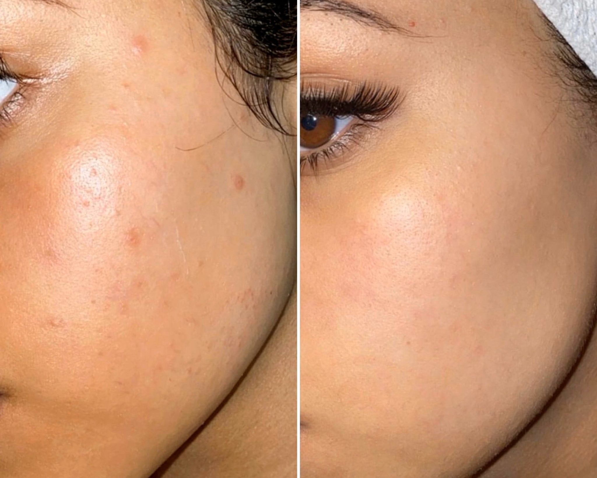 B&A: Good skin with scarring - Supple Skin Co