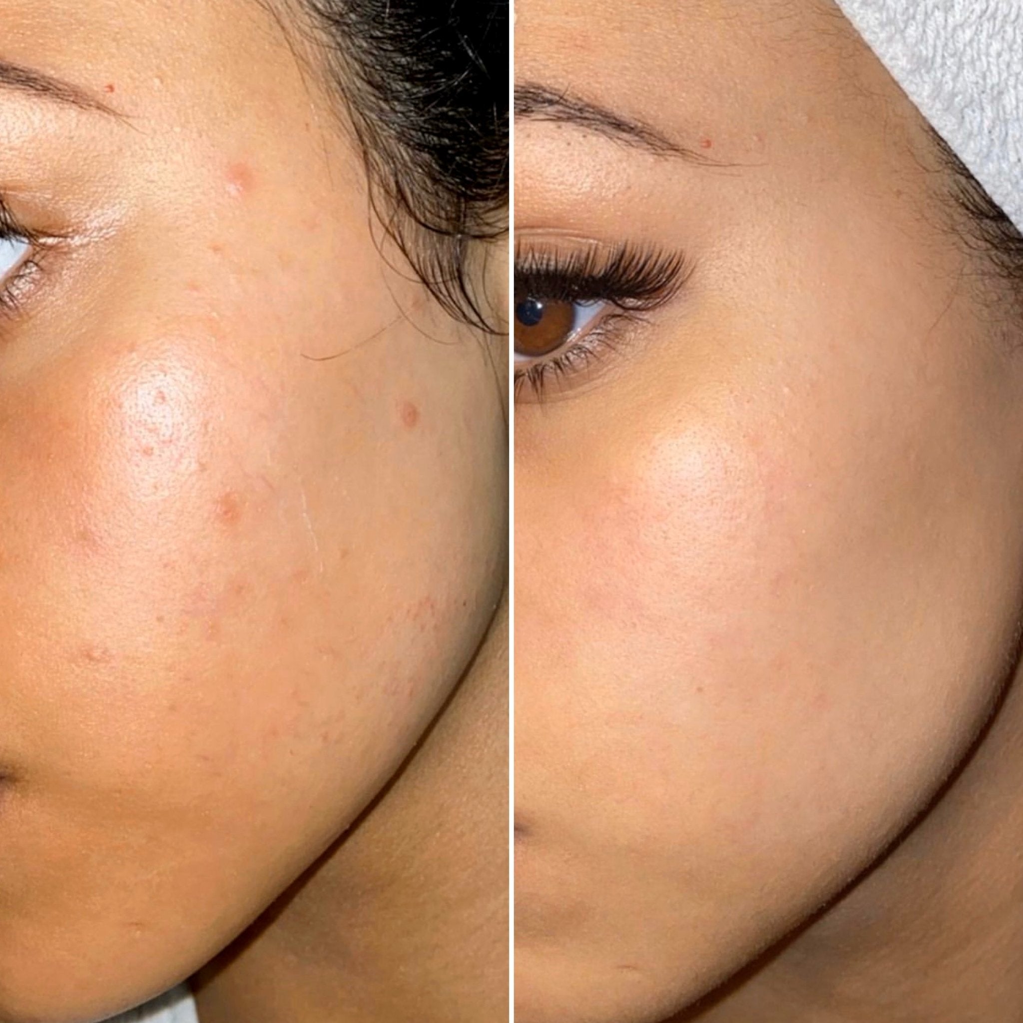 B&A: Good skin with scarring - Supple Skin Co