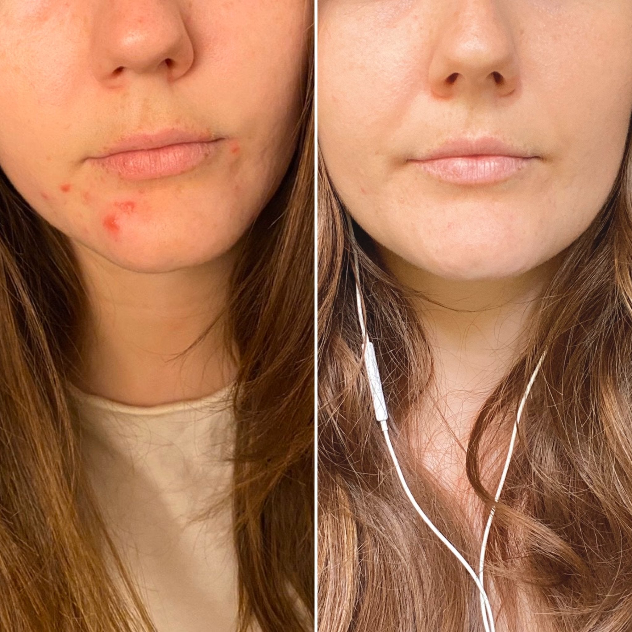 B&A Hormonal Acne Lower Face - Supple Skin Co