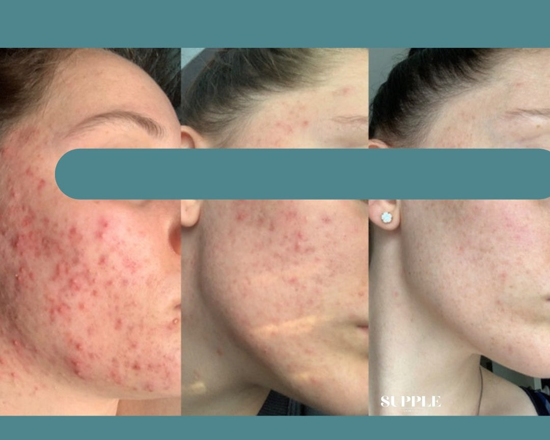 Skincare is a journey not a marathon - Supple Skin Co